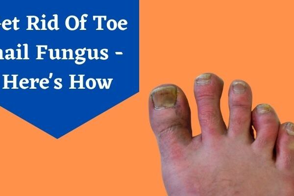 Toe nail Fungus