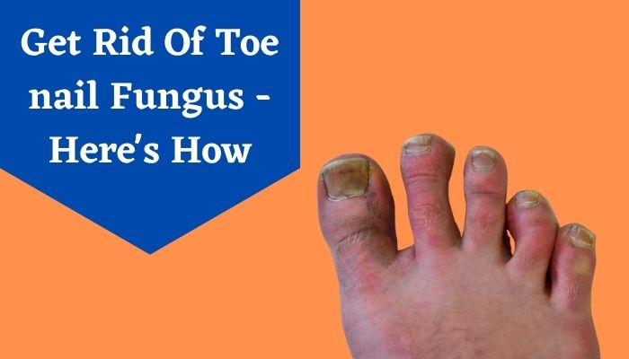 Get Rid Of Toe nail Fungus – Here’s How