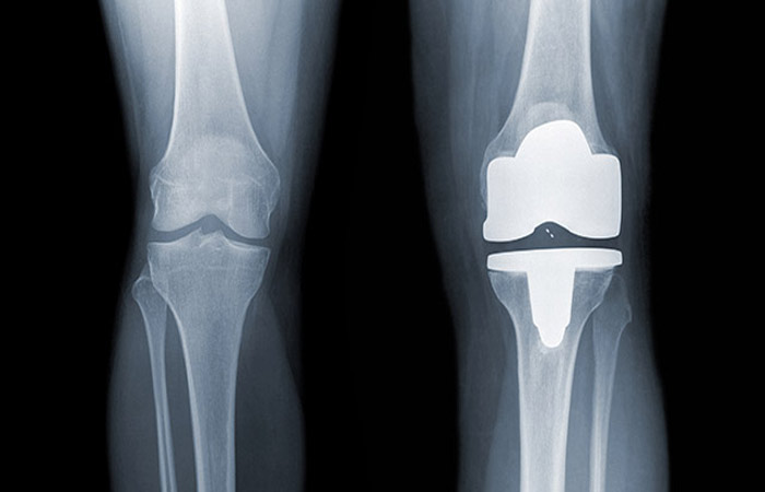Why is it worth to Opt for Health Insurance for Knee Replacement