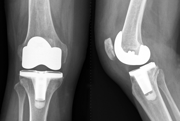 Health Insurance Cover for Knee Replacement Surgery - A Complete Guide