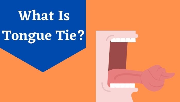 What Is Tongue Tie?
