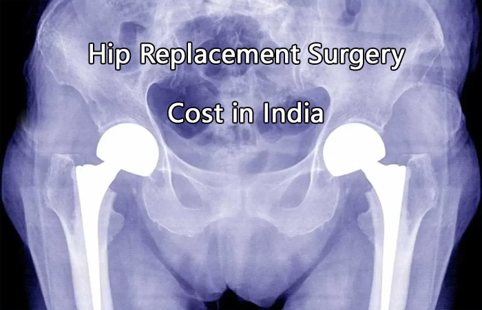 Hip Replacement Surgery Cost in India: Know Different Types and Reasons